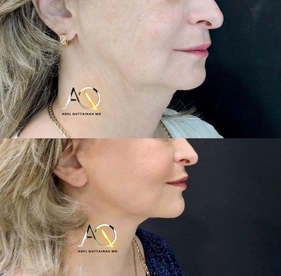 Face & Neck Lift Before and After